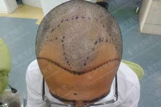 前额脱发的男明星,盘点那些勇敢面对脱发的男明星